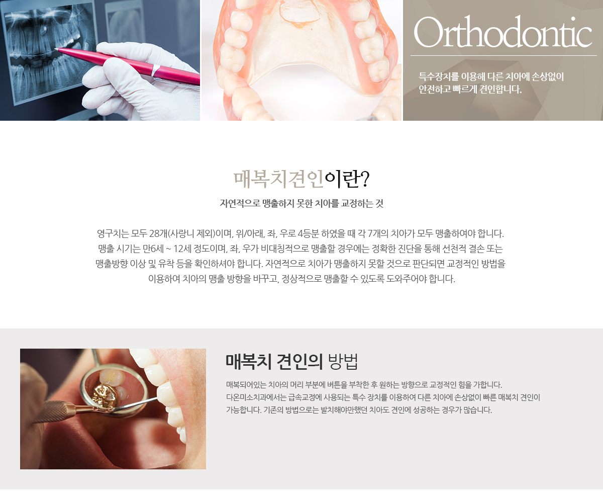 매복치견인